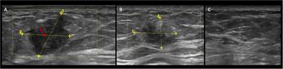 Case report: An ultrasound-based approach as an easy tool to evaluate hormone receptor-positive HER-2-negative breast cancer in advanced/metastatic settings: preliminary data of the Plus-ENDO study